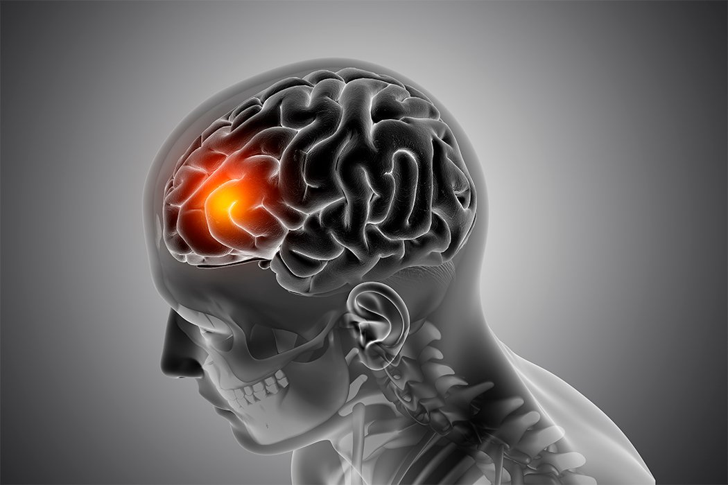 Accidente cerebrovascular